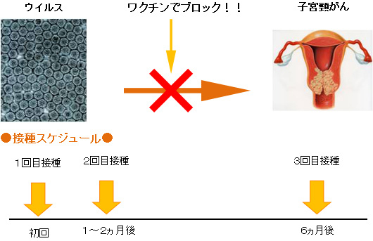 子宮頸がん予防ワクチン