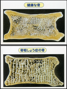 骨粗鬆症