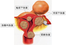 子宮筋腫